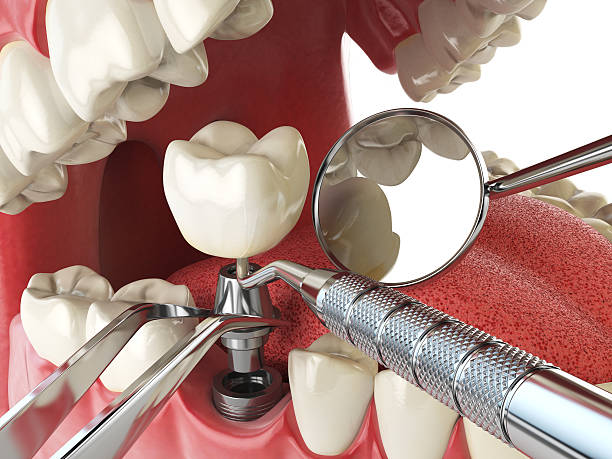 Best Emergency Dentist for Knocked-Out Tooth in Crockett, TX